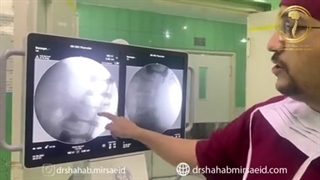 جراحی شکستگی مهره کمر