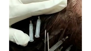 استفاده از نخ های محرک رشد مو، به روزترین روش برای درمان ریزش مو