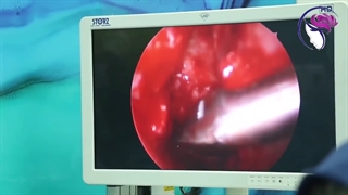 فیلم همزمان عمل زیبایی بینی و اندوسکوپی سینوس