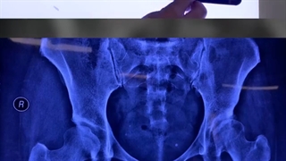 جراحی ترمیمی به روش استوتومی گانز در نیمه در رفتگی مفصل ران