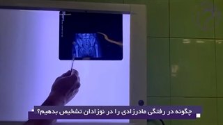 چگونه دررفتگی مادرزادی در نوزادان را تشخیص بدیم؟