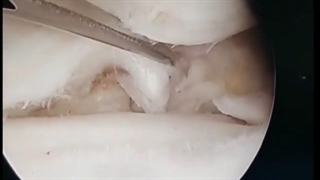 ترمیم پارگی روت یا ریشه مینیسک داخلی