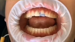 ونیر کامپوزیت