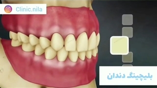 بلیچینگ دندان ابرسانی پوست