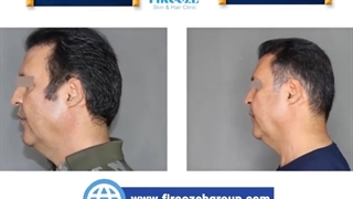 فیلم قبل و بعد هایفوتراپی، تزریق بوتاکس و تزریق فیلر زیر چشم و خط خنده