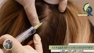 مزوتراپی برای کنترل ریزش مو پیلینگ شیمیایی