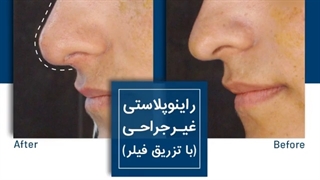 نمونه تزریق فیلر