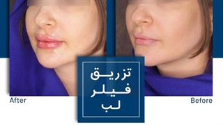 نمونه تزریق فیلر لب
