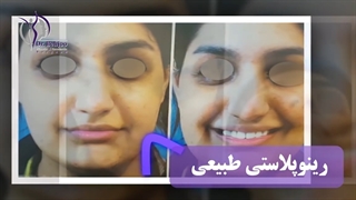 فیلم جراحی بینی طبیعی
