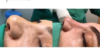 فیلم جراحی بینی بلافاصله پس از جراحی