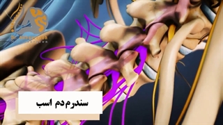 درباره سندرم دم اسب چه می دانید؟