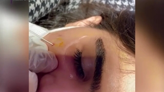 فیلم واقعی و بدون سانسور تزریق نانوفت روی صورت