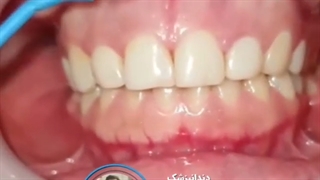 اصلاح طرح لبخند با افزایش طول تاج دندان