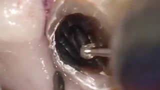 ترمیم پوسیدگی دندان