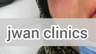 انجام تیکسل جهت رفع خشکی چشم تحت نظر خانم دکتر همتیان درکلینیک تخصصی جُوان