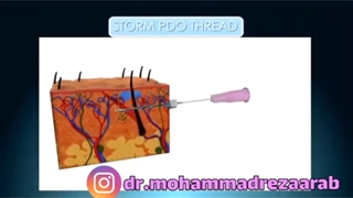 لیفت صورت با نخ چگونه انجام می شود؟