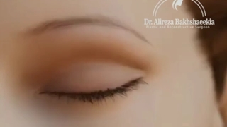 بلفاروپلاستی