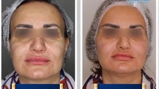 فیلم نتیجه عالی هایفوتراپی صورت، تزریق فیلر زیر چشم، گونه و مزو غبغب