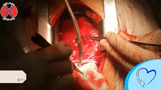 تعویض دریچه بدنبال اندوکاردیت عفونی ( فیلم عمل قلب باز)