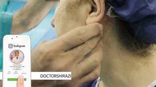 توده در ناحیه گردن همراه با تورم