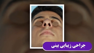 فیلم جراحی زیبایی بینی در مردان