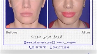 تزریق چربی صورت | دکتر خوروش