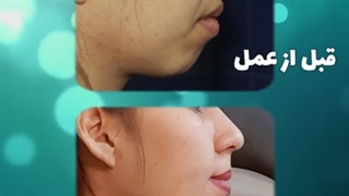 جراحی پروتز چانه | دکتر یحیوی