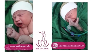 تولد نوزاد تپل 4.5 کیلویی با زایمان طبیعی