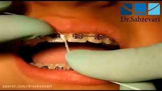 بهداشت دهان در ارتودنسی ثابت - 1