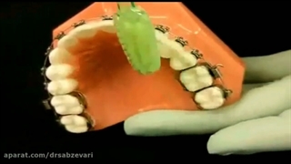 بهداشت دهان در ارتودنسی ثابت - 2