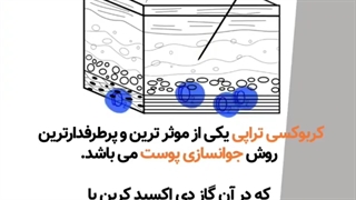 نحوه انجام کربوکسی تراپی آکنه