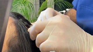 نحوه تزریق هیر فیلر