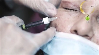 فیلم واقعی تزریق فیلر زیر چشم برای درمان چروک، گودی و پف زیر چشم