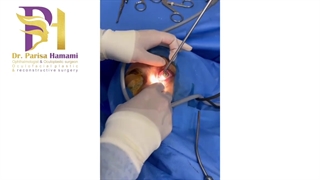 فیلم واقعی جراحی مجرای اشکی به روش اندوسکوپی بدون بخیه