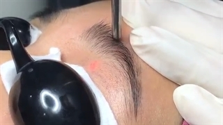 نکاتی درباره لیفت ابرو با لیزر که نمیدانستید!