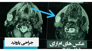 خارج کردن تومور پاروتید در خانم جوان
