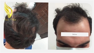 فیلم واقعی قبل و بعد کاشت موی طبیعی