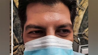 رفع خطوط پیشانی با تزریق ژل