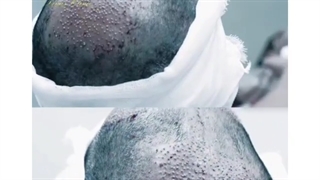 فیلم واقعی و بدون سانسور کاشت موی طبیعی