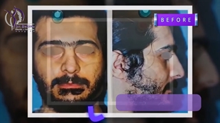 فیلم جراحی بینی برادران دوقلو در اتاق عمل