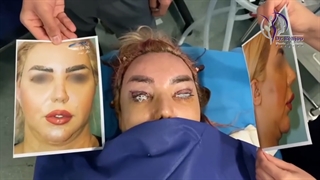 فیلم واقعی لیفت اندوسکوپی شقیقه و ابرو