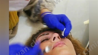 تزریق ژل جهت اصلاح فرم بینی توسط خانم دکتر همتیان درکلینیک تخصصی جُوان