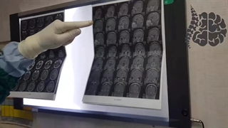 جراحی موفقیت آمیز تومور مخچه در خانم جوان