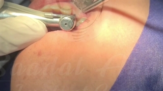 ایمپلنت دکتر دهقان دندان شیری