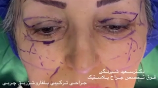 جراحی همزمان بلفاروپلاستی و تزریق چربی | دکتر سعید شیرنگی