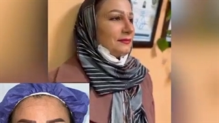 نمونه جراحی بینی طبیعی دکتر سعید شیرنگی