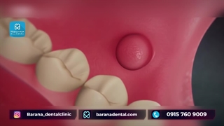 لیزر درمانی آبسه لثه چگونه است؟ آر اف فرکشنال