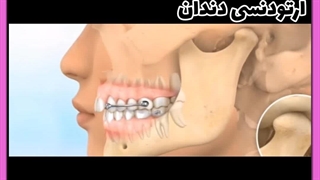 ارتودنسی عصب‌کشی