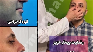 جراحی زیبایی بینی بدون بی هوشی