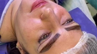 بلفاروپلاستی در کلینیک آرتین